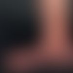 Atrophie der Haut: Acrodermatitis chronica atrophicans. Flächenhafte knittrige Atrophie mit livid...