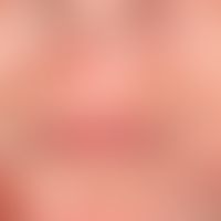 Artefakte: schmierig krustig belegte flache Ulzera. Kein Hinweis für Akne. Kein Hinweis für sonst...