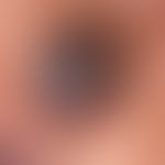 Basalzellkarzinom pigmentiertes: langsam wachsender, zentral ulzerierter, völlig symptomloser Kno...