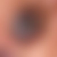 Basal cell carcinoma pigmented: slowly growing, centrally ulcerated, completely asymptomatic lump...