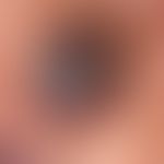 Basalzellkarzinom pigmentiertes: langsam wachsender, zentral ulzerierter, völlig symptomloser Kno...