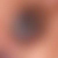 Basal cell carcinoma pigmented: slowly growing, centrally ulcerated, completely asymptomatic lump...
