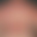 Flagellantendermatitis:&nbsp;streifige und&nbsp;flächenhafte, entzündliche Hautveränderungen nach...