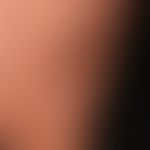 Sklerodermie zirkumskripte:&nbsp;&nbsp;profunde zirkumskripte Sklerodermie (deep morphea); selten...