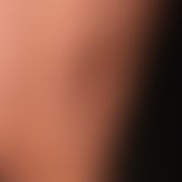 Circumscript scleroderma: profound circumscript scleroderma (deep morphea); rare subtype of circu...