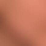 &nbsp;Pusteln und entzündliche und nicht-entzündliche Papeln: Acne&nbsp;papulopustulosa mit folli...