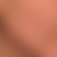 &nbsp;Pusteln und entzündliche und nicht-entzündliche Papeln: Acne&nbsp;papulopustulosa mit folli...