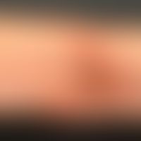 Cytostatic drugs: Extravasation after application of a cytostatic drug
