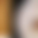 Naevus vom Rücken eines 84jährigen Mannes, der bereits vor 8 Jahren ein Melanom hatte. Aufgefalle...