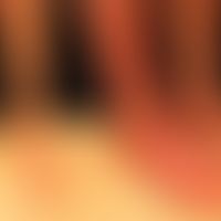 Acrodermatitis chronica atrophicans: 69jährige Frau. Seit 4 Monaten rechter Unterschenkel flächig...