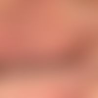 Chronische seborrhoische Liddermatitis: chronische unscharf begrenzte schuppige Plaques. Vermehrt...