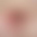 Kutane Endometriose: Seit mehreren Jahre langsam wachsender, oberflächenglatter, 2,0 cm großer, p...