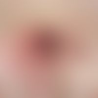 Red node: bulging elastic, red, surface smooth node with cyclic pain symptoms (cutaneous endometr...