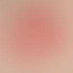 Drug reaction, fixed (detail): Two red, sharply defined, moderately itchy plaques which have exis...