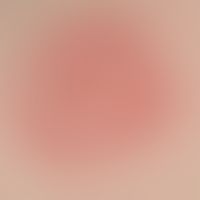 Drug reaction, fixed (detail): Two red, sharply defined, moderately itchy plaques which have exis...