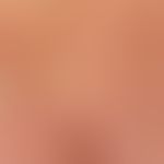 Atrophodermia idiopathica et progressiva: large, red, confluent, hardly palpable, smooth, asympto...