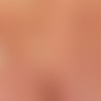 Atrophodermia idiopathica et progressiva: large, red, confluent, hardly palpable, smooth, asympto...