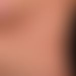 Atrophodermia idiopathica et progressiva: slowly progressive, large, light-grey, non-symptomatic ...
