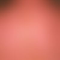Dermatitis solaris: painful blistering of the skin that is sharply marked on areas exposed to sun...