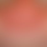 Dermatitis solaris: scharf auf Sonnenlicht-exponierte Areale gezeichnete, flächenhafte, schmerzha...