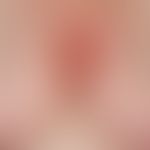 Differential diagnosis seborrheic eczema: aggregated inflammatory papules localized in the seborr...