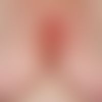 Differential diagnosis seborrheic eczema: aggregated inflammatory papules localized in the seborr...