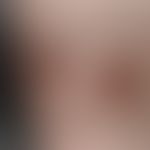 Ekthyma:&nbsp;an beiden Unterschenkeln, disseminierte, 0,4-1,0 cm große, schmerzhafte, scharf beg...