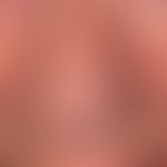 Schwere aktinische Elastose der Gesichtshaut: flächenhafte Verdickung der Haut mit weißliche Plaq...