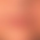Wrinkle treatment with filling materials: the ideal filling material is biocompatible, without al...