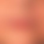 Wrinkle treatment with filling materials: the ideal filling material is biocompatible, without al...