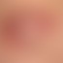 Boils: painful, highly inflammatory, bulging elastic lump.
