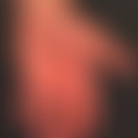 Hand-Fuß-Mund-Krankheit:&nbsp;seit etwa 1 Woche, &nbsp;schmerzhafte, Bläschen,Pusteln und Papeln&...