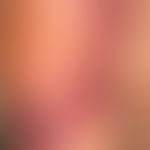 Hämatom:&nbsp;nicht ganz frisches Hämatom der Schulterregion&nbsp;nach Sturzereignis. Unscharfe&n...