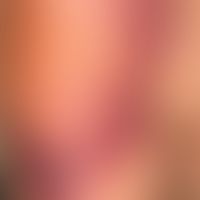 Haematoma: not quite fresh haematoma of the shoulder region after a fall; blurred boundaries of t...
