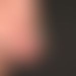Keratoakanthom, klassischer Typ:&nbsp; innerhalb von wenigen Wochen gewachsener, ca. 2,0&nbsp;cm ...