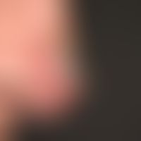 Keratoakanthoma, classic type: hard, reddish, central keratotic lump, measuring about 2.0 cm in d...