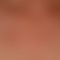 Keratosis actinica erythematous type: multiple red, rough, slightly painful plaques when spread o...