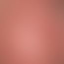 Keratosis actinica, keratotischer Typ: Bei einem 75-jährigen entwickelten sich in den letzten Jah...
