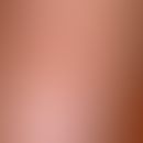 Keratosis seborrhoeic (plaque type): flat, regularly bordered, little pigmented, non-irritant pla...