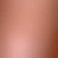 Keratosis seborrhoeic (plaque type): flat, regularly bordered, little pigmented, non-irritant pla...