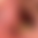 Differenzialdiagnose orale Leukoplakie: verruköse retroangulär lokalisierte weiße Plaque bei Lich...