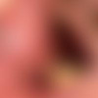 Differenzialdiagnose orale Leukoplakie: verruköse retroangulär lokalisierte weiße Plaque bei Lich...