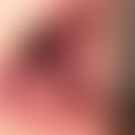 Lichen planus mucosae: less symptomatic white plaques on the mucous membrane of the tongue; known...