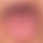 Lichen planus mucosae: white plaques with few symptoms, which condense on the sides and at the ti...