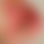 Lichen planus mucosae: Infestation of the mucous membrane of the mouth and the back of the tongue...