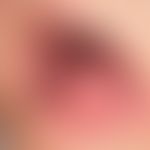 Lichen planus mucosae: less symptomatic white plaques on the buccalmucosa and on the mucous membr...