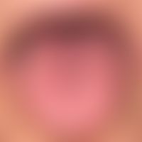 Lingua plicata: pronounced longitudinal and transversal furrow of the tongue surface, especially ...