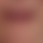 Altersinvolution der Lippen
