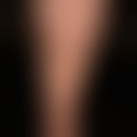 Livedo racemosa: irregular, bizarre, not closed circular segments (ankle region), as pioneering m...
