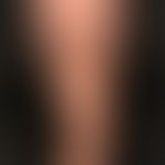 Livedo racemosa: irregular, bizarre, not closed circular segments on the lower leg and ankle regi...